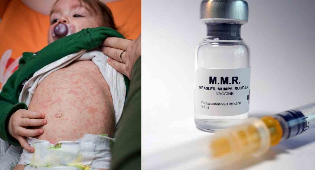 Measles Resurgence Worldwide