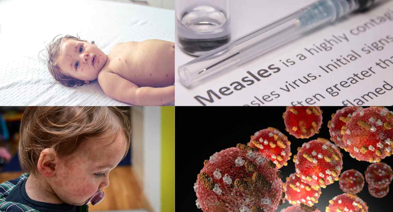 Measles Surge
