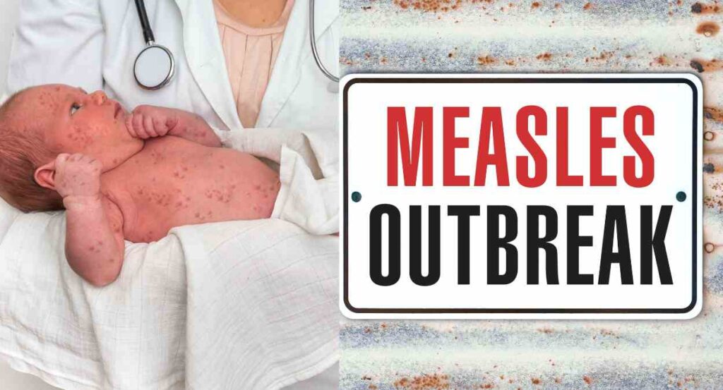 The Stealth Threat of Measles