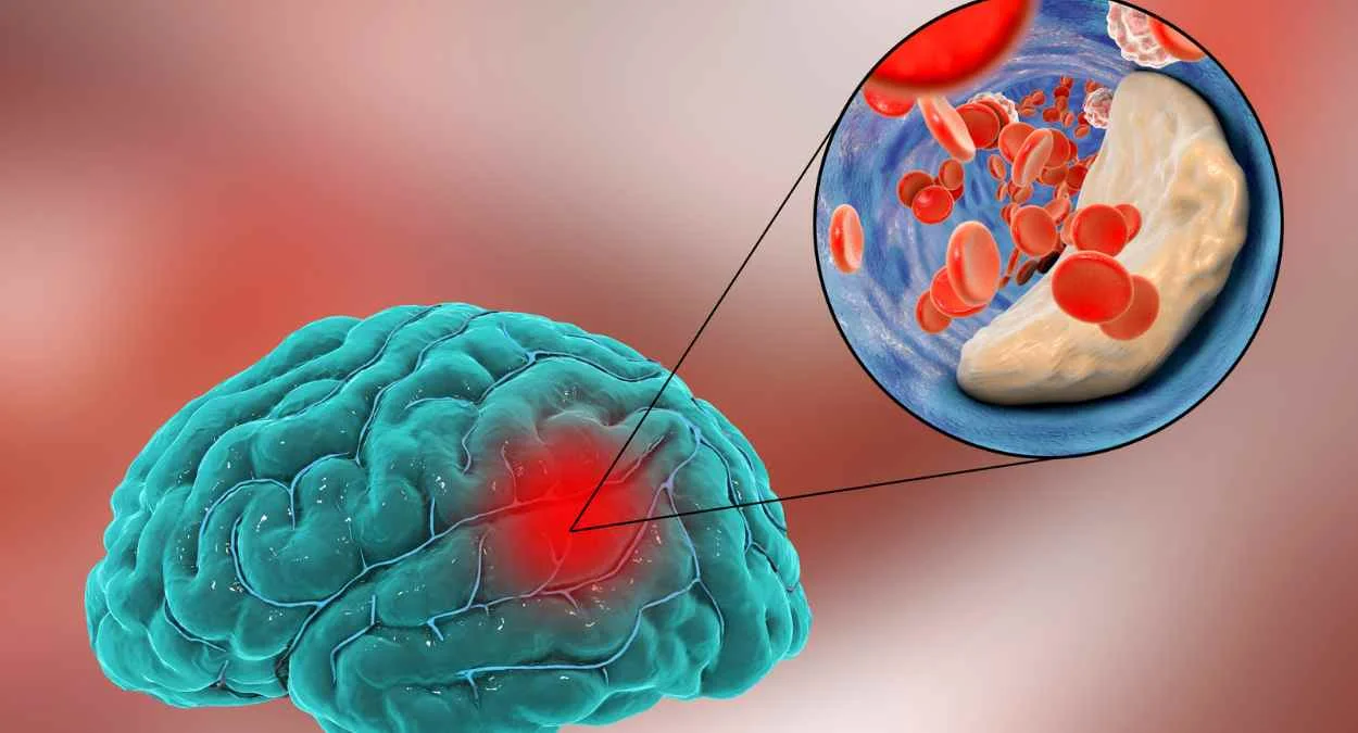 The Global Rise of Neurological Disorders: A Concerning Trend